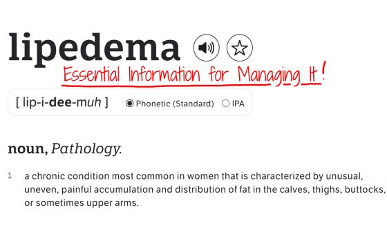 Lipedema: Essential Information for Managing It
