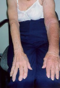 Patient After MLD Treatment